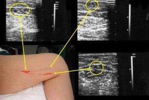 Дуплексное сканирование вен, сосудов и артерий нижних конечностей