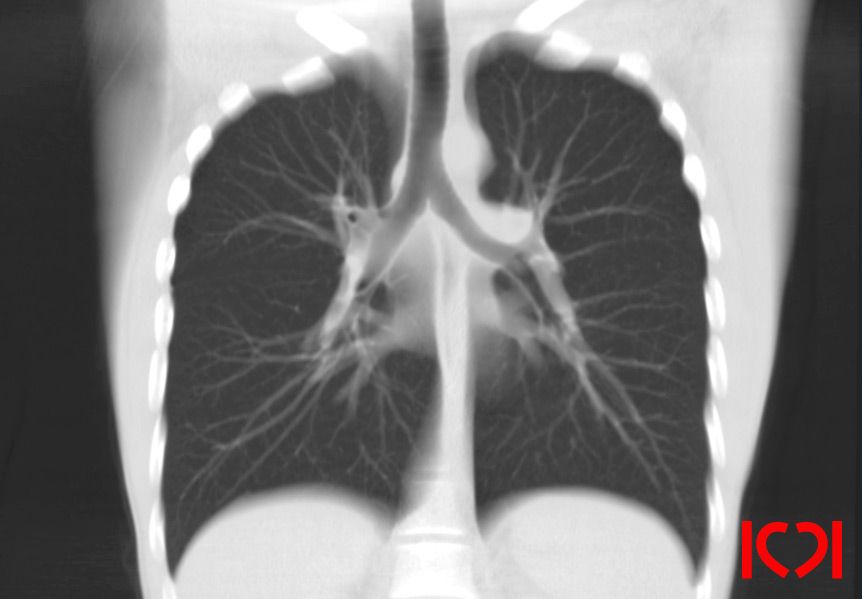 КТ-лёгких во фронтальной плоскости