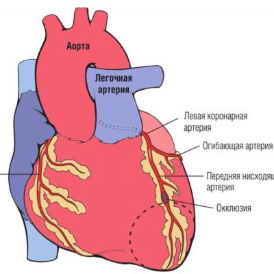Хронические окклюзии коронарных артерий