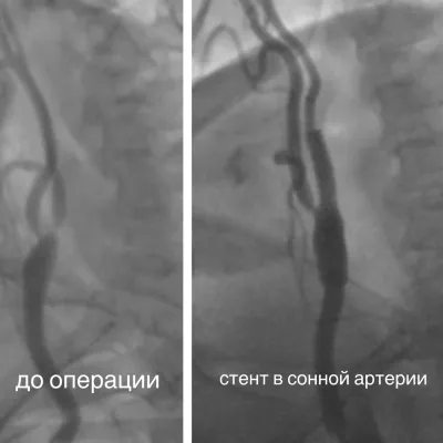 В КардиоКлинике успешно стентируют сонные артерии